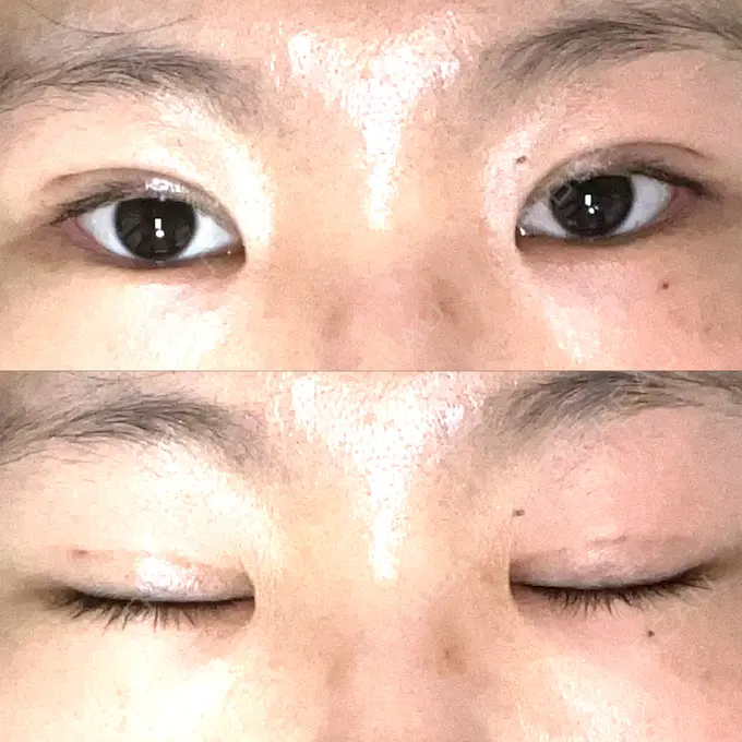 二重埋没 オアシス美容外科 DAY 12 メイン用