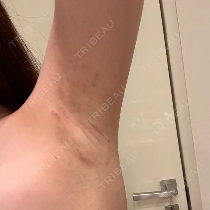 ワキ汗治療（レーザー） ルラ美容クリニック 渋谷本院 DAY 4 メイン用