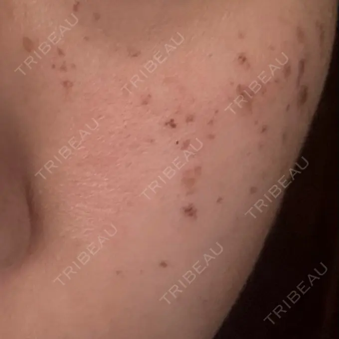 エレクトロポレーション / 毛穴洗浄（ハイドラフェイシャルなど） / ルメッカ ルラ美容クリニック 広島院 DAY 0 メイン用