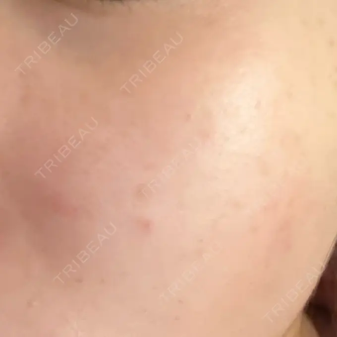 エレクトロポレーション / 毛穴洗浄（ハイドラフェイシャルなど） / ルメッカ ルラ美容クリニック 広島院 AFTER メイン用