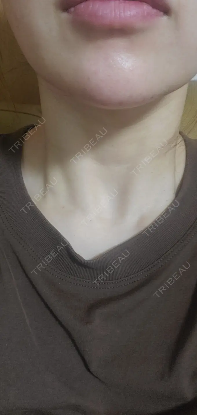 ヒアルロン酸注入（あご） / シワ取りボトックス / ボトックス（額） 湘南美容クリニック 浜松院 AFTER メイン用