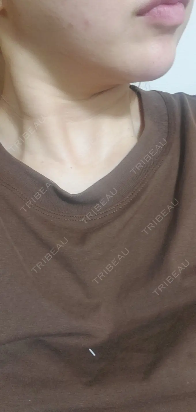 ヒアルロン酸注入（あご） / シワ取りボトックス / ボトックス（額） 湘南美容クリニック 浜松院 DAY 5 メイン用