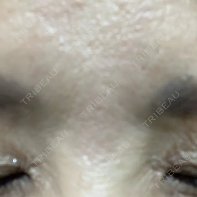 ボトックス（眉間） TCB東京中央美容外科 三島院 DAY 9 メイン用