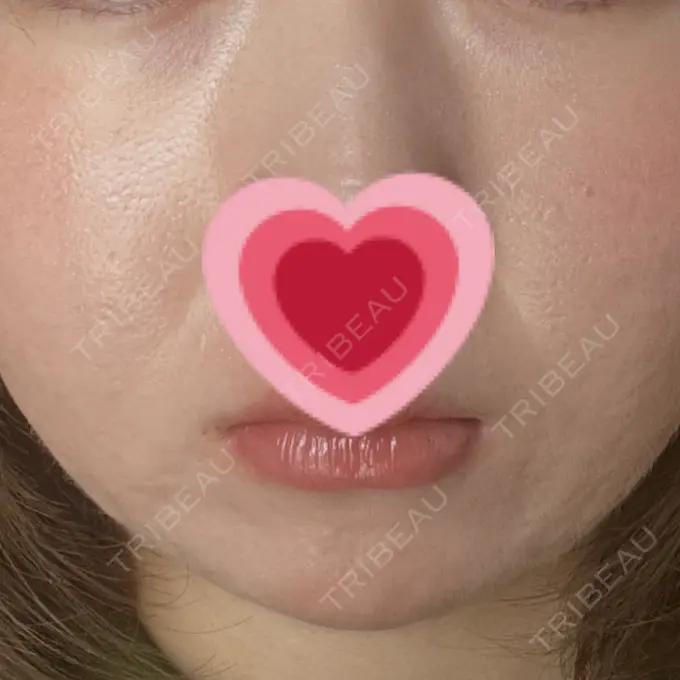 ボトックス（あご） / ヒアルロン酸注入（あご） / ボトックス（エラ・小顔） TCB東京中央美容外科 宇都宮院 AFTER メイン用