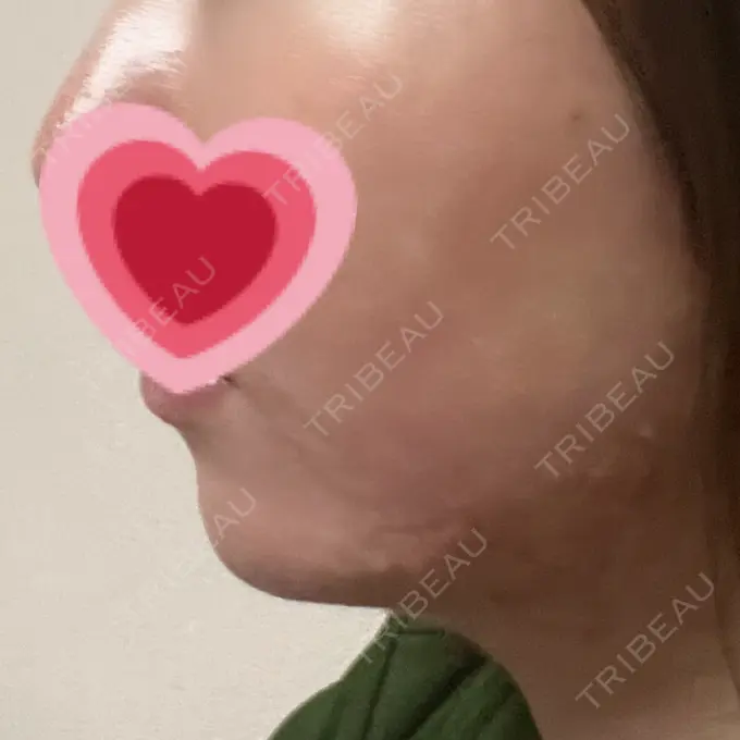 ボトックス（あご） / ヒアルロン酸注入（あご） / ボトックス（エラ・小顔） TCB東京中央美容外科 宇都宮院 DAY 161 メイン用