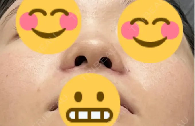 小鼻縮小（切開） 渋谷の森クリニック DAY 7 メイン用