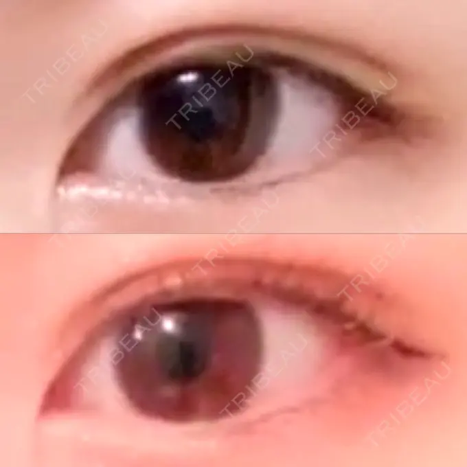 二重切開 よこはまエーブクリニック DAY 32 メイン用