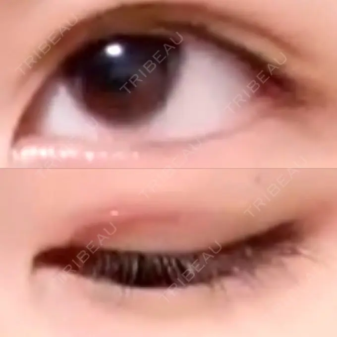 二重切開 よこはまエーブクリニック DAY 32 メイン用