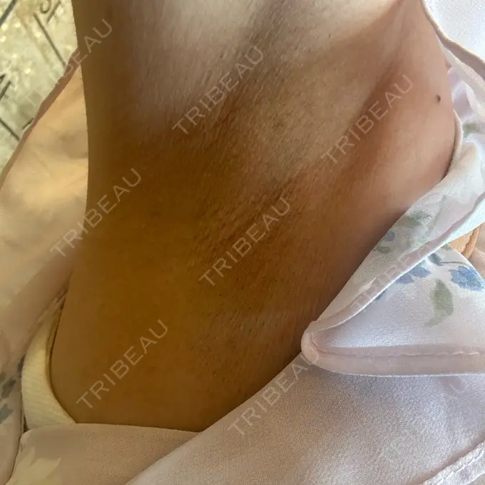 医療脱毛（ワキ） ルラ美容クリニック 神戸院 DAY 0 メイン用