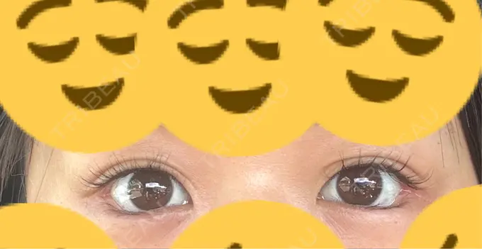 目尻切開 / タレ目形成・グラマラスライン（埋没） / ボトックス（人中） LOUIS CLINIC 二子玉川院【ルイクリニック】 DAY 1 メイン用