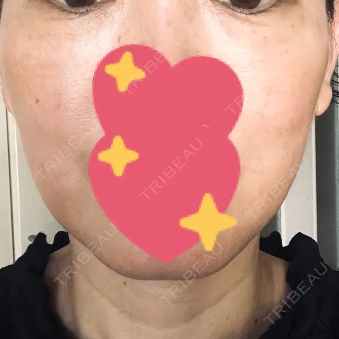 肌育注射（ジュベルックなど） B-LINE CLINIC 大阪院 DAY 20 メイン用