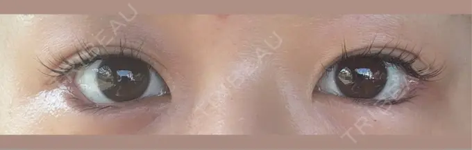 目尻切開 / タレ目形成・グラマラスライン（埋没） / ボトックス（人中） LOUIS CLINIC 二子玉川院【ルイクリニック】 DAY 2 メイン用