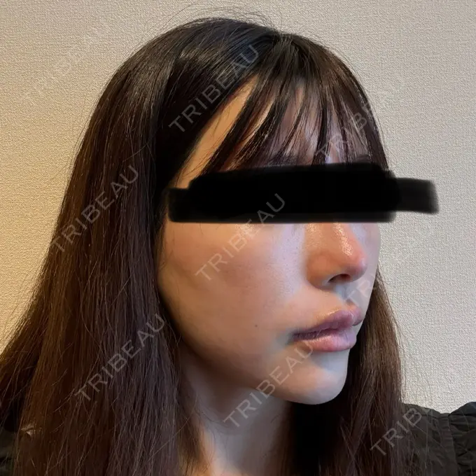 軟骨移植 湯田クリニック 銀座 AFTER メイン用