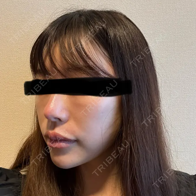 軟骨移植 湯田クリニック 銀座 DAY 188 メイン用