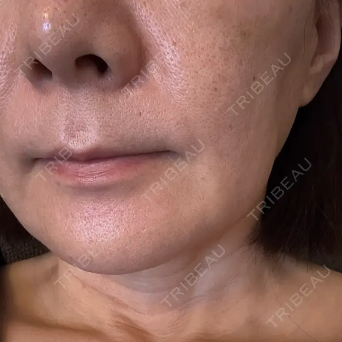 肌育注射（ジュベルックなど） SUNMELIA SKIN CLINIC AFTER メイン用