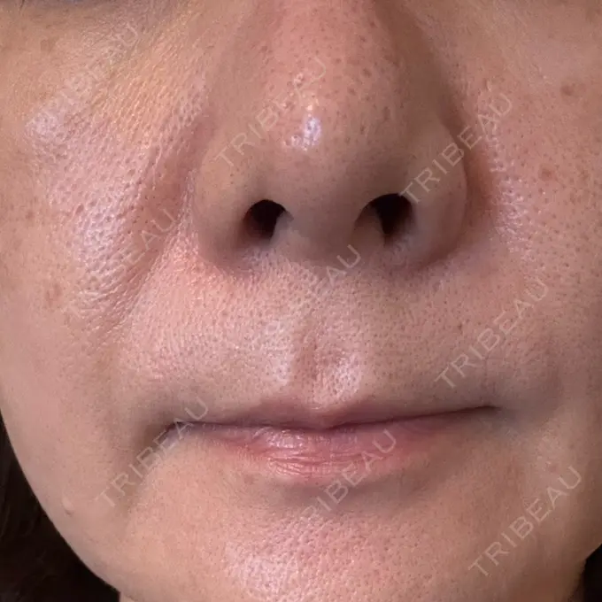 肌育注射（ジュベルックなど） SUNMELIA SKIN CLINIC DAY 7 メイン用