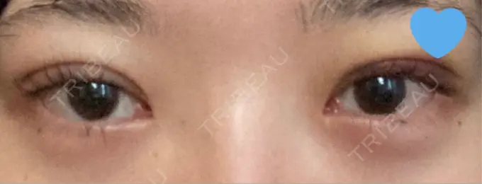 二重埋没 / クマ治療 湘南美容クリニック 博多院 DAY 6 メイン用