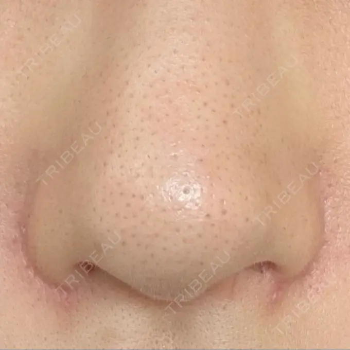 小鼻縮小（切開） GLANZ CLINIC DAY 99 メイン用