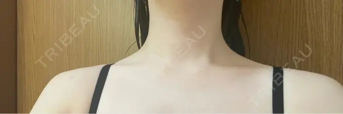 ボトックス（口角） / ボトックス（肩） TCB東京中央美容外科 浜松院 AFTER メイン用