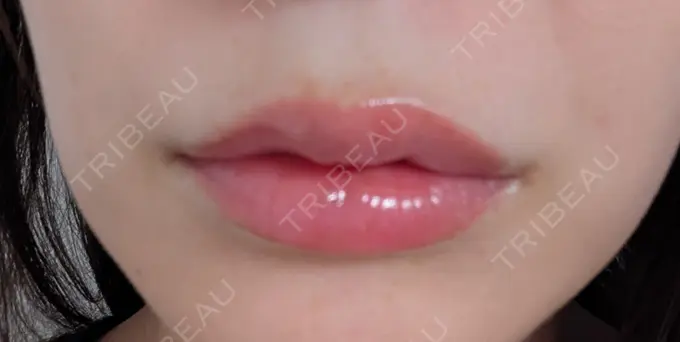 ヒアルロン酸注入（唇） 新未来クリニック AFTER メイン用