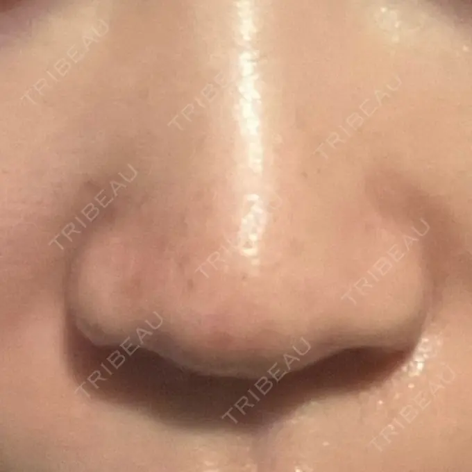 アグネス KM新宿クリニック DAY 18 メイン用