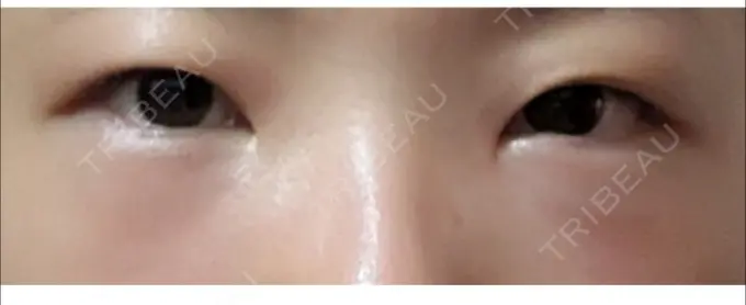 下まぶたの脂肪取り 表参道ウィズ・クリニック DAY 1 メイン用