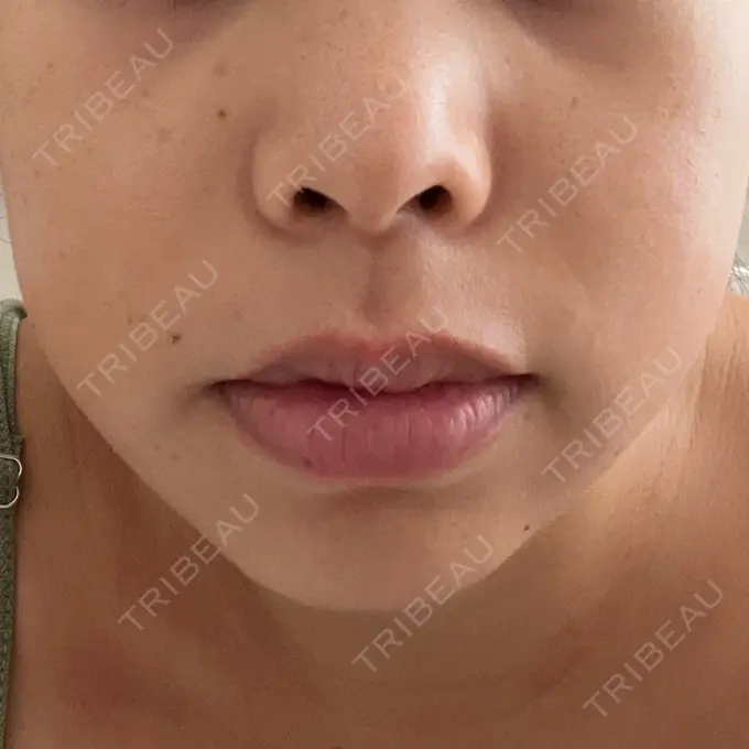 ハイフ（顔） Designo Clinic （デジーノクリニック） DAY 0 メイン用