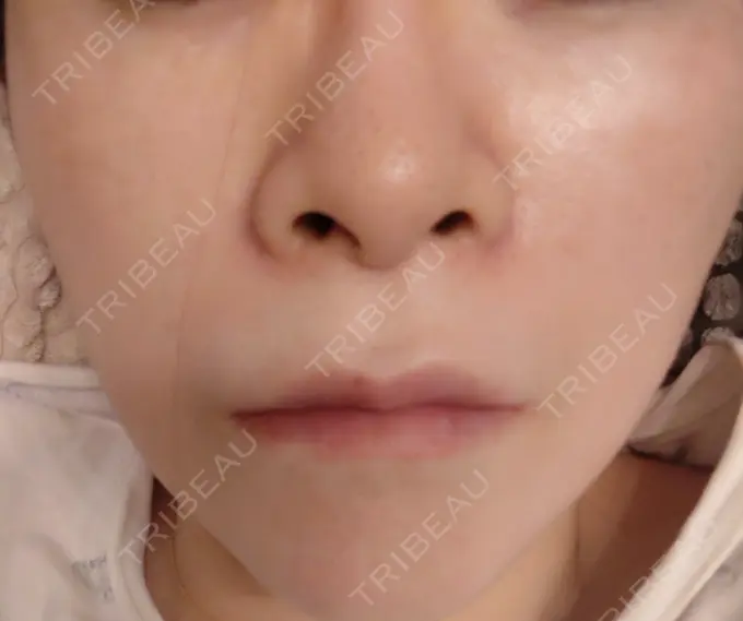 ボトックス（エラ・小顔） 新宿TAクリニック DAY 4 メイン用