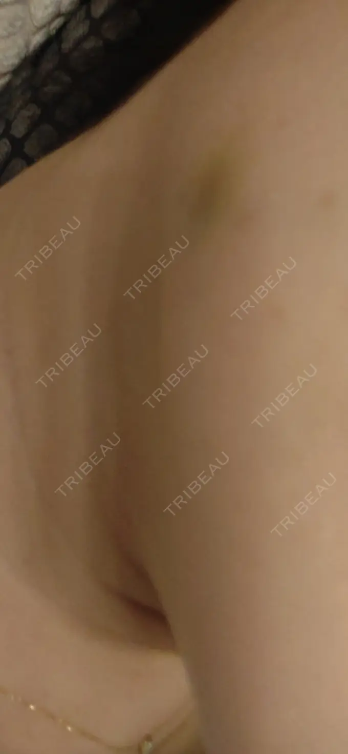 ボトックス（エラ・小顔） 新宿TAクリニック DAY 4 メイン用