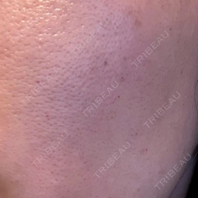 水光注射（ハリ・美肌） Chloe Cheongdam Clinic （クロエチョンダムクリニック） DAY 0 メイン用