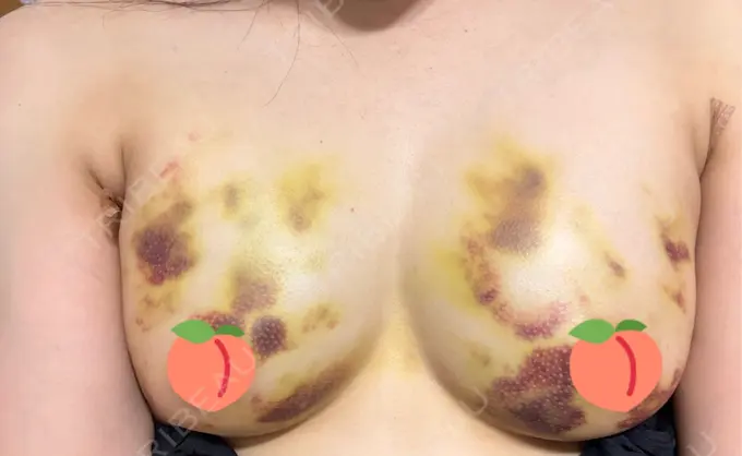 脂肪吸引（脚） / 豊胸（脂肪注入） THE CLINIC（ザ・クリニック） 福岡院 DAY 11 メイン用