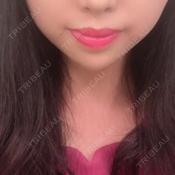 ヒアルロン酸注入（あご） TCB東京中央美容外科 新宿東口院 AFTER メイン用