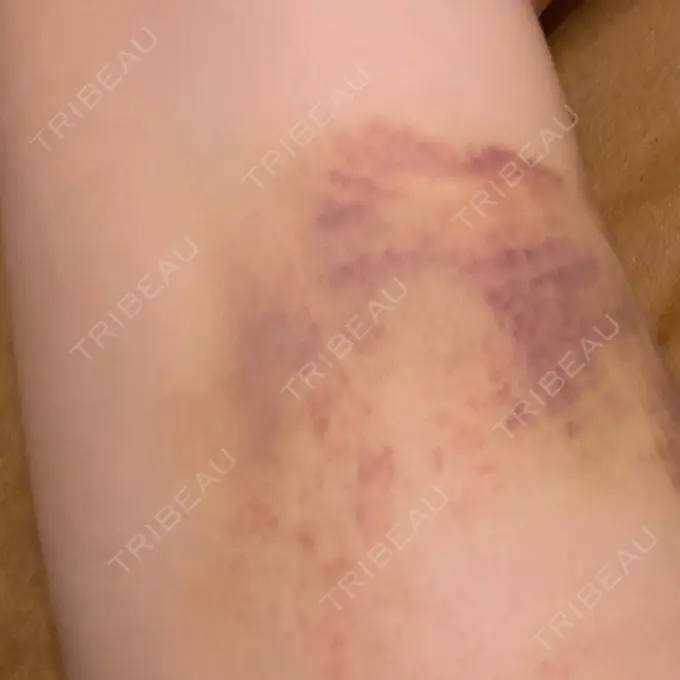 脂肪吸引（脚） / 豊胸（脂肪注入） THE CLINIC（ザ・クリニック） 福岡院 DAY 14 メイン用