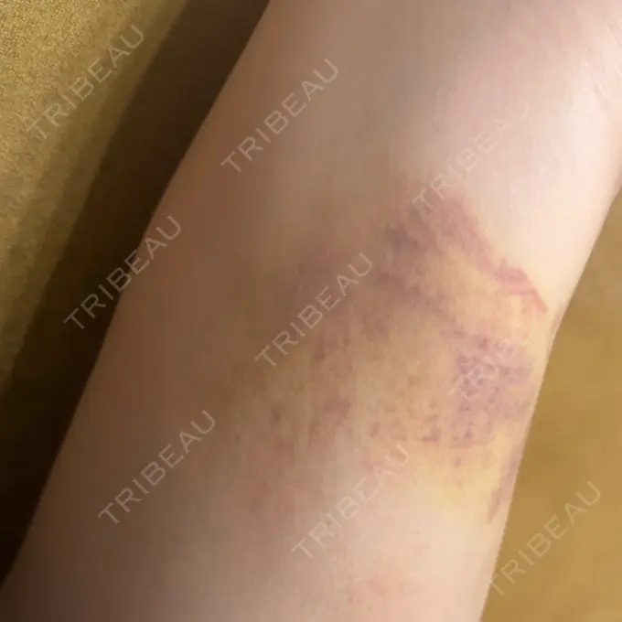 脂肪吸引（脚） / 豊胸（脂肪注入） THE CLINIC（ザ・クリニック） 福岡院 DAY 14 メイン用