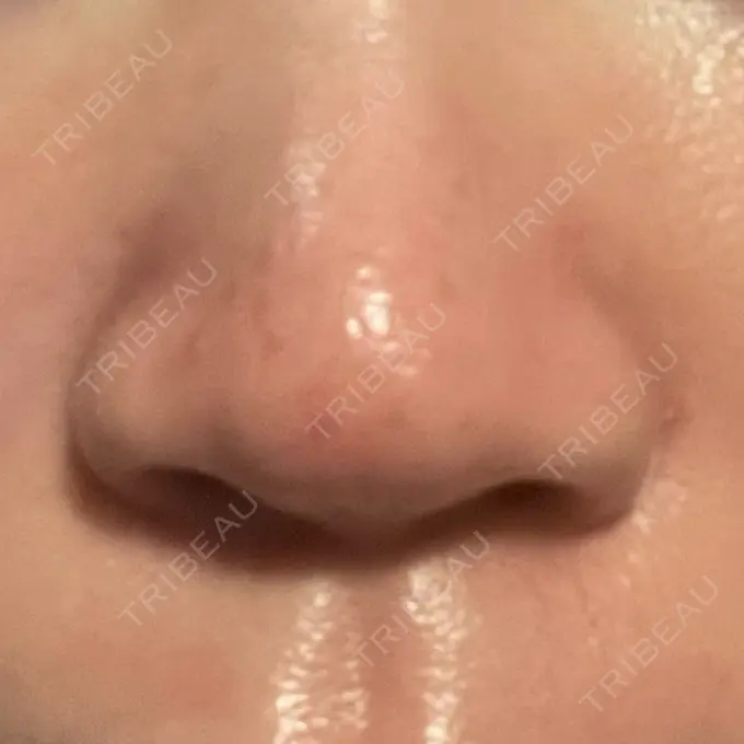 アグネス KM新宿クリニック AFTER メイン用