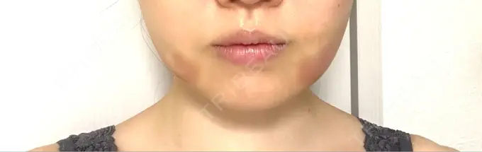 糸リフト / 脂肪吸引（顔） / 脂肪吸引注射（顔） ziz CLINIC DAY 1 メイン用