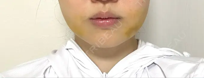 糸リフト / 脂肪吸引（顔） / 脂肪吸引注射（顔） ziz CLINIC DAY 6 メイン用