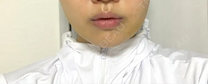 糸リフト / 脂肪吸引（顔） / 脂肪吸引注射（顔） ziz CLINIC DAY 10 メイン用