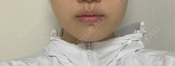 糸リフト / 脂肪吸引（顔） / 脂肪吸引注射（顔） ziz CLINIC AFTER メイン用