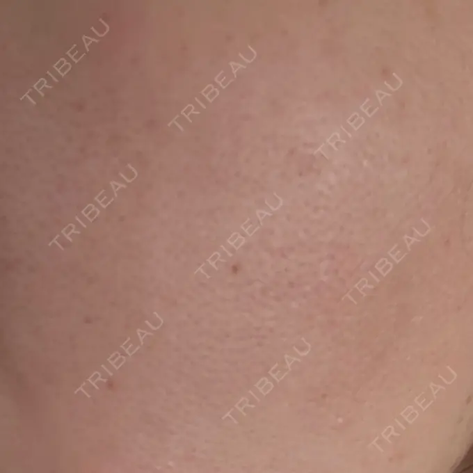 水光注射（ハリ・美肌） Chloe Cheongdam Clinic （クロエチョンダムクリニック） DAY 1 メイン用