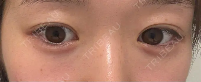 ヒアルロン酸注入（涙袋） / ボトックス（口角） AI Beauty Clinic （エーアイ美容クリニック） DAY 0 メイン用