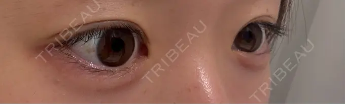 ヒアルロン酸注入（涙袋） / ボトックス（口角） AI Beauty Clinic （エーアイ美容クリニック） DAY 0 メイン用