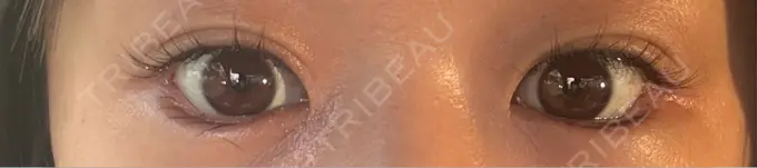 目尻切開 / タレ目形成・グラマラスライン（埋没） / ボトックス（人中） LOUIS CLINIC 二子玉川院【ルイクリニック】 DAY 4 メイン用