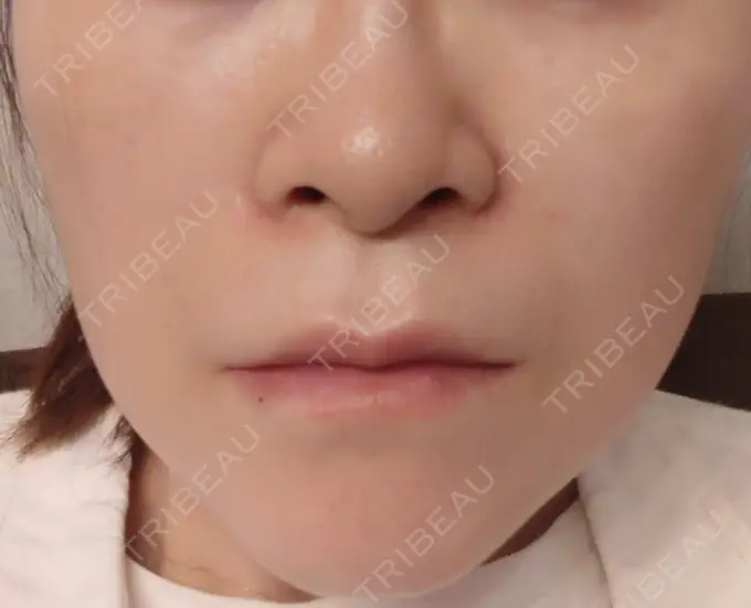 ボトックス（エラ・小顔） 新宿TAクリニック DAY 5 メイン用