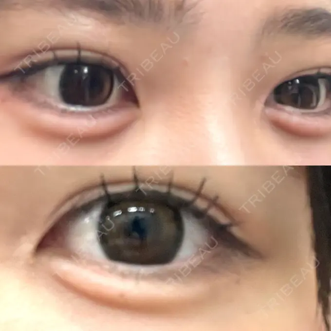 ヒアルロン酸注入（涙袋） / ボトックス（エラ・小顔） / ボトックス（タレ目） / ボトックス（目尻） 東京シルククリニック 新宿院 AFTER メイン用