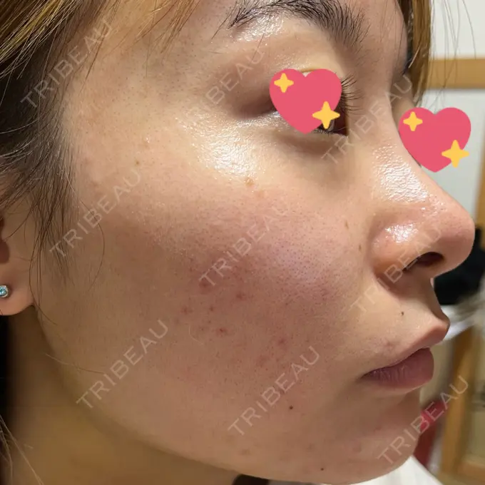 ピコフラクショナルレーザー（毛穴・ニキビ跡） ルラ美容クリニック 大宮院 / ルラスキンクリニック 大宮院 DAY 87 メイン用