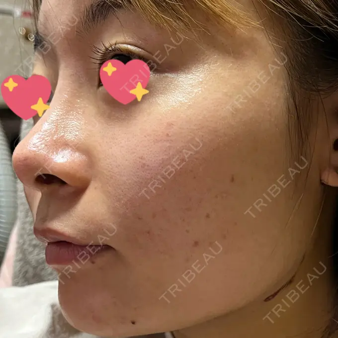 ピコフラクショナルレーザー（毛穴・ニキビ跡） ルラ美容クリニック 大宮院 / ルラスキンクリニック 大宮院 DAY 87 メイン用