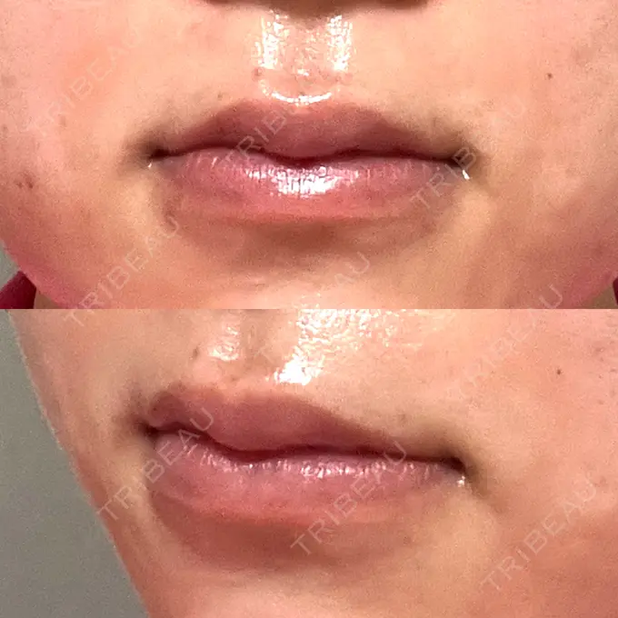 ヒアルロン酸注入（唇） 大美会クリニック 神戸院 DAY 2 メイン用