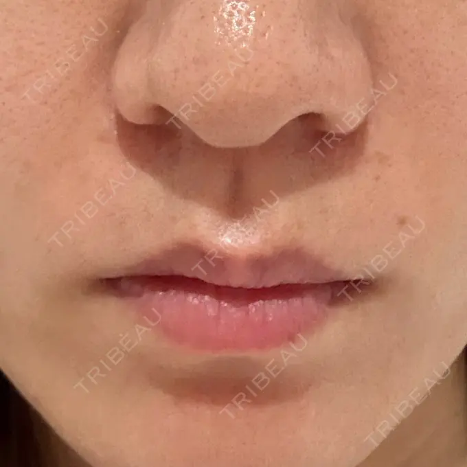 ボトックス（口角） / ボトックス（眉間） / ボトックス（目尻） ヴァージンクリニック 福岡天神院 AFTER メイン用