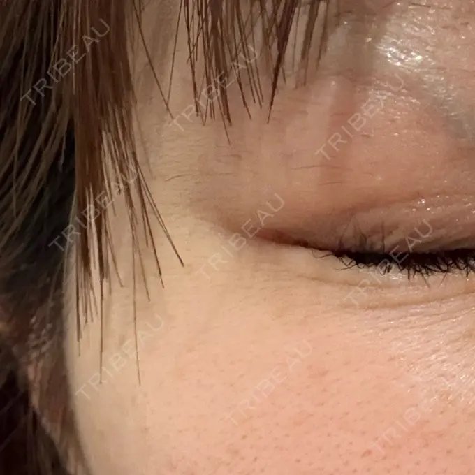 ボトックス（口角） / ボトックス（眉間） / ボトックス（目尻） ヴァージンクリニック 福岡天神院 DAY 4 メイン用